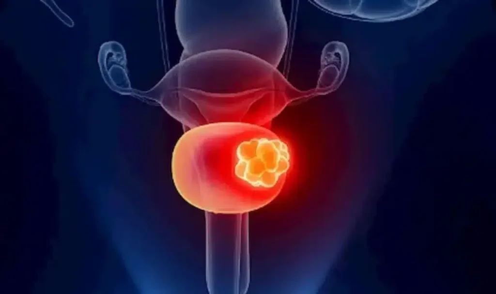 منظارية لعلاج الإرتجاع المثاني الحالبي