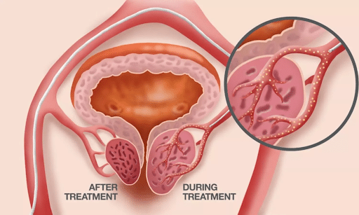 What is the latest treatment for enlarged prostate