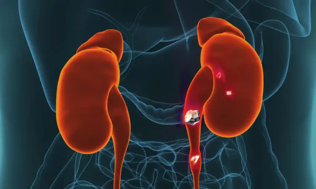 تفتيت الحصى بالليزر