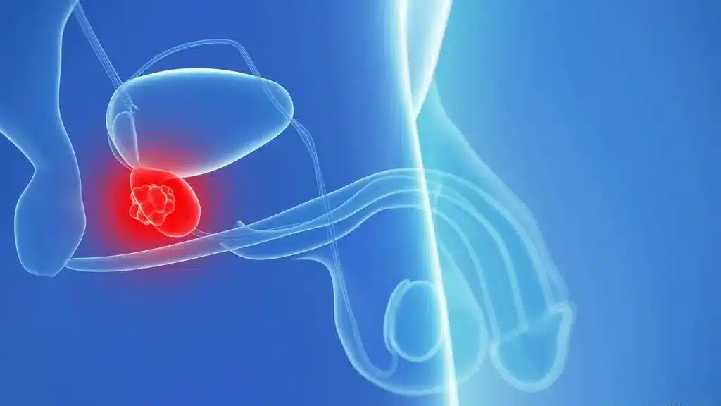 هل يعود الانتصاب بعد استئصال البروستاتا