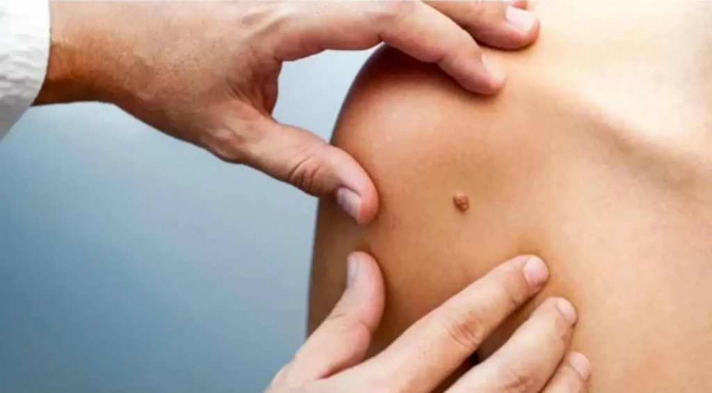 تقوية المناعة ضد فيروس الورم الحليمي