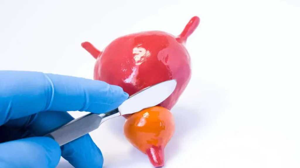 benign prostatic enlargement