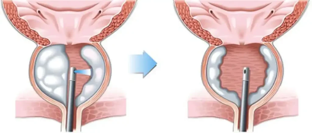 ازالة البروستاتا بالتبخير