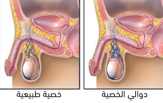 أعراض دوالي الخصية