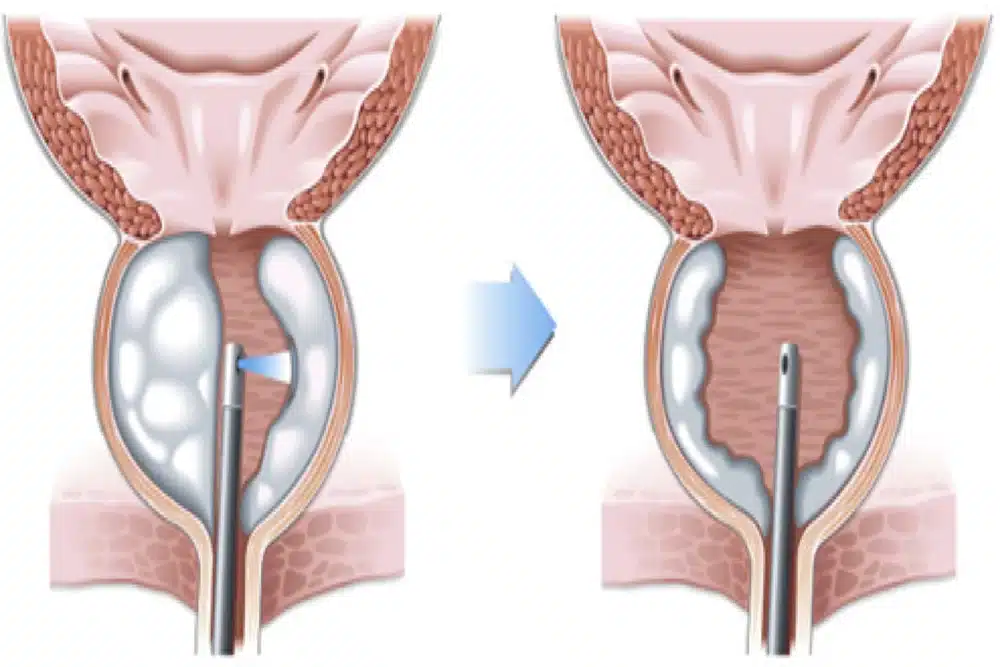كيفية علاج تضخم البروستات بالريزوم