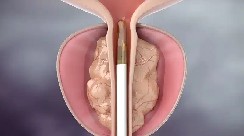 تقنية الرزيوم الأسرع في علاج البروستاتا