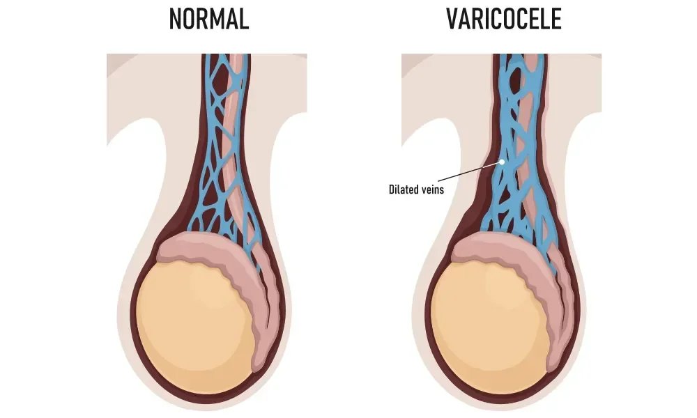 هل دوالي الخصية اليسرى تسبب العقم