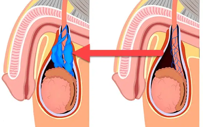 دوالي الخصية - مركز البروفيسور السامرائي الطبي في دبي استشاري المسالك البولية هل دوالي الخصية تزول مع الوقت؟