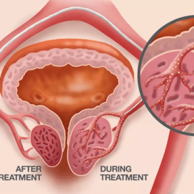 What is the latest treatment for enlarged prostate