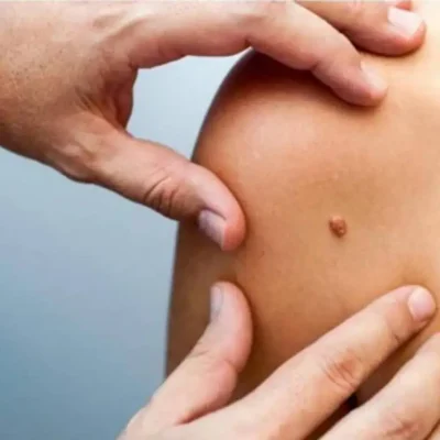 تقوية المناعة ضد فيروس الورم الحليمي