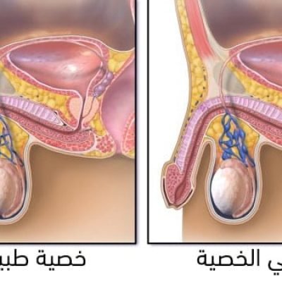 أعراض دوالي الخصية