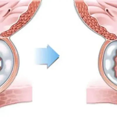 ازالة البروستاتا بالتبخير