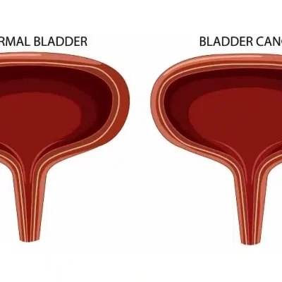 اعراض سرطان المثانة