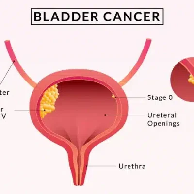 اعراض سرطان المثانة عند للرجال واسبابه وطرق العلاج