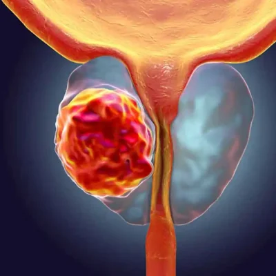 Amelioration of survival outcome after early prostatectomy