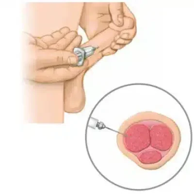 سعر حقن الانتصاب