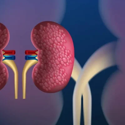 علاج الاعتلال الكلوي السكري