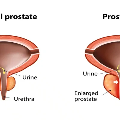 التهاب البروستاتا المزمن غير البكتيري