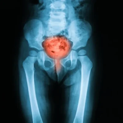 علاج التهاب المثانة وحرقان البول