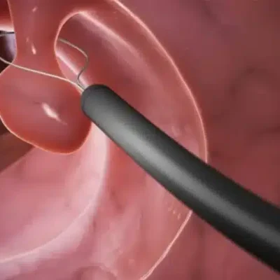 كيف يمكن علاج تضخم البروستات بالتبخير؟
