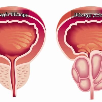 الفرق بين سرطان البروستاتا وتضخم البروستاتا