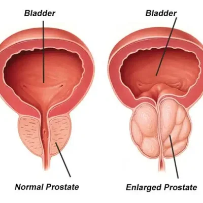 الفرق بين التهاب وتضخم البروستاتا