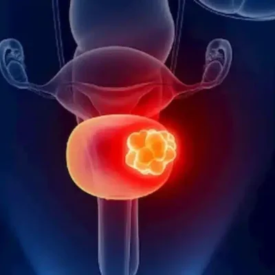 منظارية لعلاج الإرتجاع المثاني الحالبي