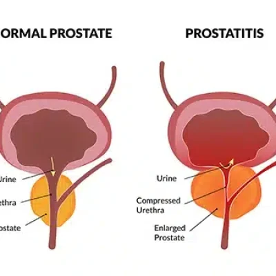 هل التهاب البروستاتا يزول بدون علاج