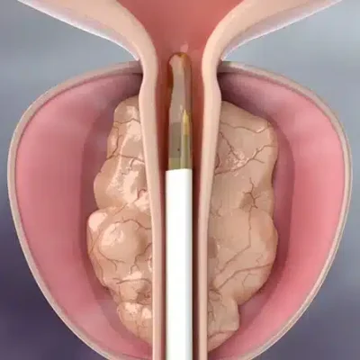 تقنية الرزيوم الأسرع في علاج البروستاتا