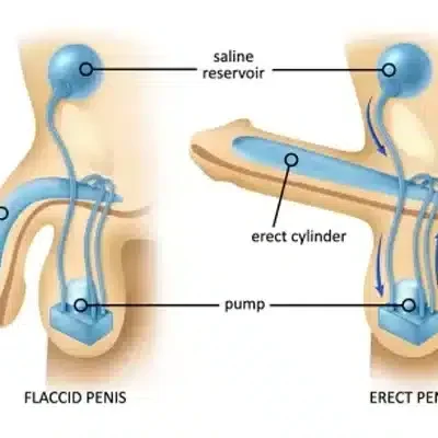 أسرع علاج لضعف الانتصاب
