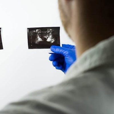 تضخم البروستاتا