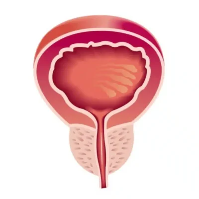 هل يمكن الشفاء من تضخم البروستاتا